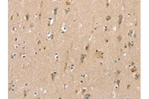The image on the left is immunohistochemistry of paraffin-embedded Human brain tissue using ABIN7192520(SLC6A8 Antibody) at dilution 1/30, on the right is treated with synthetic peptide. (SLC6A8 antibody)