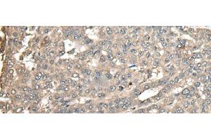 Immunohistochemistry of paraffin-embedded Human liver cancer tissue using ATXN3 Polyclonal Antibody at dilution of 1:100(x200) (Ataxin 3 antibody)