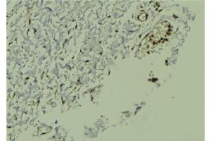 ABIN6272970 at 1/100 staining Human breast cancer tissue by IHC-P.