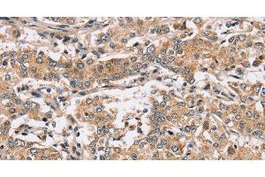 Immunohistochemistry of paraffin-embedded Human liver cancer using PPP1CC Polyclonal Antibody at dilution of 1:40 (PPP1CC antibody)