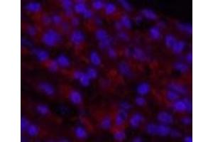 Immunofluorescence analysis of Human lung cancer tissue using Cleaved-NOTCH1 (V1754) Polyclonal Antibody at dilution of 1:200. (Notch1 antibody  (Cleaved-Val1754))