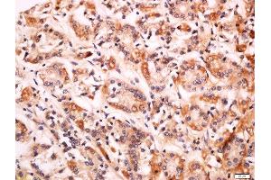 Formalin-fixed and paraffin embedded human gastric carcinoma labeled with Anti-CD99L2 Polyclonal Antibody, Unconjugated  at 1:200 followed by conjugation to the secondary antibody and DAB staining.