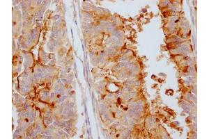 IHC image of ABIN7127379 diluted at 1:100 and staining in paraffin-embedded human endometrial cancer performed on a Leica BondTM system.