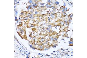 Immunohistochemistry of paraffin-embedded human breast cancer using NDE1 antibody (ABIN5974277) at dilution of 1/100 (40x lens). (NDE1 antibody)