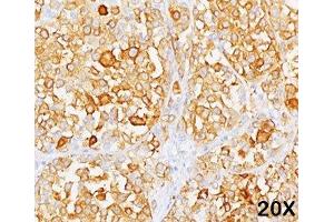 Formalin/paraffin human melanoma stained with MART-1 / Melan-A antibody (M2-9E3). (MLANA antibody)