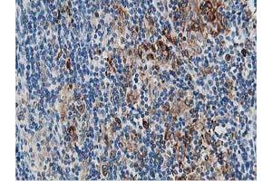 Immunohistochemical staining of paraffin-embedded Human lymphoma tissue using anti-PTPN1 mouse monoclonal antibody. (PTPN1 antibody)