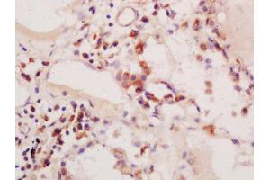 Formalin-fixed and paraffin embedded human colon carcinoma labeled with Anti-phospho-PIK3C3(Ser164)Polyclonal Antibody, Unconjugated  at 1:200 followed by conjugation to the secondary antibody and DAB staining