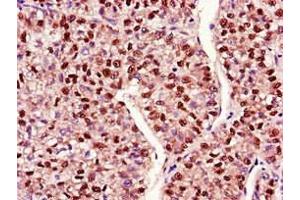 Immunohistochemistry of paraffin-embedded human liver cancer using ABIN7150711 at dilution of 1:100 (MAP2K4 antibody  (AA 259-398))