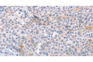 Immunohistochemistry of paraffin-embedded Human liver cancer using STK4 Polyclonal Antibody at dilution of 1:70 (STK4 antibody)