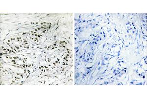 Peptide - +Immunohistochemistry analysis of paraffin-embedded human breast carcinoma tissue, using ERF antibody. (ERF antibody  (Internal Region))