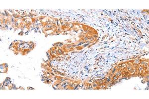 Immunohistochemistry of paraffin-embedded Human cervical cancer tissue using AP1B1 Polyclonal Antibody at dilution 1:70 (AP1B1 antibody)