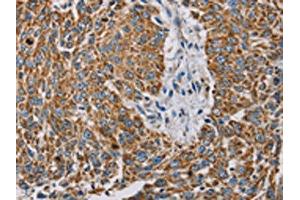 The image on the left is immunohistochemistry of paraffin-embedded Human lung cancer tissue using ABIN7130290(MTFP1 Antibody) at dilution 1/30, on the right is treated with fusion protein. (Mtfp1 antibody)