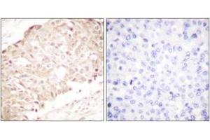 Immunohistochemistry analysis of paraffin-embedded human breast carcinoma tissue, using SENP1 Antibody. (SENP1 antibody  (AA 1-50))