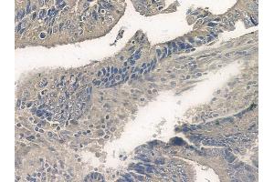 ABIN6255502 and ABIN6267099 at 1/100 staining human colon carcinoma by IHC-P. (BIM antibody  (pSer77))