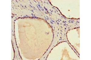 Immunohistochemistry of paraffin-embedded human prostate cancer using ABIN7170686 at dilution of 1:100 (STAMBP antibody  (AA 1-424))