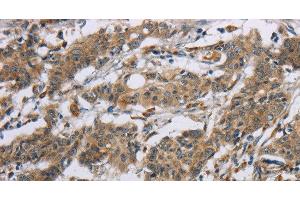 Immunohistochemistry of paraffin-embedded Human gastic cancer using SYN2 Polyclonal Antibody at dilution of 1:40 (SYN2 antibody)