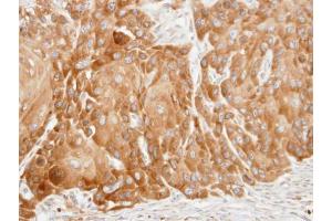 IHC-P Image Immunohistochemical analysis of paraffin-embedded SCC15 xenograft, using VDP/p115, antibody at 1:100 dilution. (USO1 antibody  (C-Term))