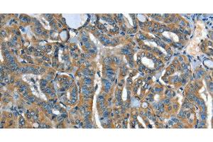Immunohistochemistry of paraffin-embedded Human thyroid cancer tissue using ADCY4 Polyclonal Antibody at dilution 1:45 (ADCY4 antibody)