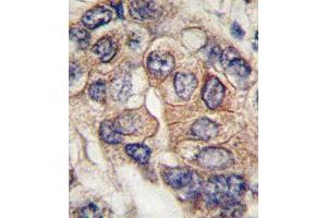 Formalin-fixed and paraffin-embedded human hepatocarcinoma tissue reacted with PDGFRA Antibody  (ABIN392024 and ABIN2841799) , which was peroxidase-conjugated to the secondary antibody, followed by DAB staining. (PDGFRA antibody  (AA 698-727))