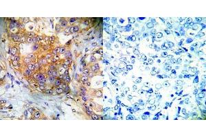 Immunohistochemical analysis of paraffin- embedded human breast carcinoma tissue using 4E-BP1 (Ab-65) antibody (E022001). (eIF4EBP1 antibody)