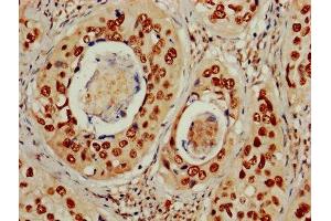 IHC image of ABIN7150328 diluted at 1:600 and staining in paraffin-embedded human cervical cancer performed on a Leica BondTM system. (MCM2 antibody  (AA 2-904))