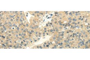 Immunohistochemistry of paraffin-embedded Human breast cancer using UBL4A Polyclonal Antibody at dilution of 1/40 (UBL4A antibody)