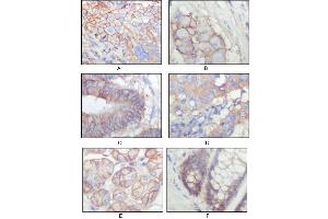 Immunohistochemical analysis of paraffin-embedded human lung squamous cell carcinoma (A), lung adenocarcinoma (B), colon carcinoma (C), breast carcinoma (D), normal sublingual gland (E), normal rectal (F), showing membrane localization with DAB staining using EphB3 antibody. (EPH Receptor B3 antibody  (AA 39-212))