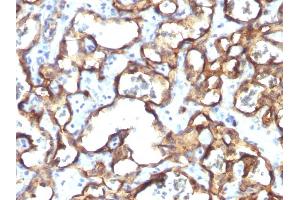 Formalin-fixed, paraffin-embedded human Angiosarcoma stained with CD34 Monoclonal Antibody (HPCA1/1171) (CD34 antibody)