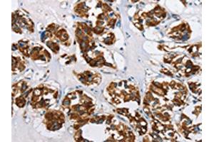 IHC analysis of paraffin-embedded human thyroid cancer tissue, using HINT2 antibody (1/50 dilution, 200X magnification).