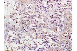 Formalin-fixed and paraffin embedded human lung carcinoma labeled with Anti-SPARC Polyclonal Antibody, Unconjugated (ABIN738141) at 1:200 followed by conjugation to the secondary antibody and DAB staining. (SPARC antibody  (AA 101-200))