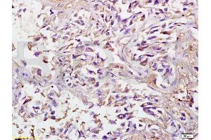 Formalin-fixed and paraffin embedded human lung carcinoma labeled with Anti-SPARC Polyclonal Antibody, Unconjugated (ABIN738141) at 1:200 followed by conjugation to the secondary antibody and DAB staining.