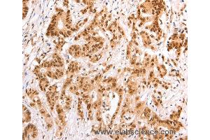 Immunohistochemistry of Human esophagus cancer using TAX1BP1 Polyclonal Antibody at dilution of 1:60 (TAX1BP1 antibody)