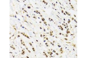 Immunohistochemistry of paraffin-embedded Human breast cancer using RAD50 Polyclonal Antibody at dilution of 1:100 (40x lens). (RAD50 antibody)