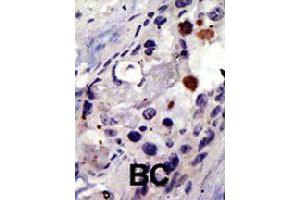Formalin-fixed and paraffin-embedded human cancer tissue reacted with PSMD4 polyclonal antibody  , which was peroxidase-conjugated to the secondary antibody, followed by AEC staining. (PSMD4/ASF antibody  (AA 300-328))