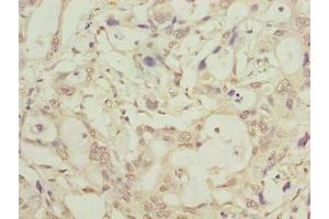 Immunohistochemistry of paraffin-embedded human pancreatic cancer using ABIN7158058 at dilution of 1:100 (LRTM1 antibody  (AA 1-212))
