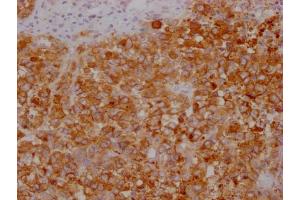 IHC image of ABIN7180656 diluted at 1:100 and staining in paraffin-embedded human colon cancer performed on a Leica BondTM system. (CEACAM5 antibody)