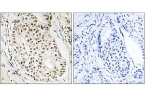 Immunohistochemistry analysis of paraffin-embedded human breast carcinoma tissue, using HNRNPUL2 Antibody.