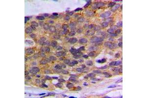 Immunohistochemical analysis of PLA2G4A staining in human breast cancer formalin fixed paraffin embedded tissue section.