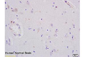 Formalin-fixed and paraffin embedded human glioma tissue labeled with Anti-PCNA Polyclonal Antibody, Unconjugated (ABIN676583) at 1:200 followed by conjugation to the secondary antibody and DAB staining (PCNA antibody  (AA 151-261))