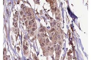 ABIN6272333 at 1/100 staining Human breast cancer tissue by IHC-P. (KIF13B antibody  (C-Term))