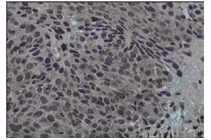 Immunohistochemical staining of human cervical cancer tissue (40X magnification) using  Protein A purified anti-Jagged-1 antibody. (JAG1 antibody  (Internal Region))