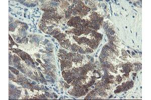 Immunohistochemical staining of paraffin-embedded Adenocarcinoma of Human ovary tissue using anti-DOK7 mouse monoclonal antibody. (DOK7 antibody)