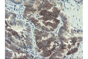 Immunohistochemical staining of paraffin-embedded Adenocarcinoma of Human ovary tissue using anti-DOK7 mouse monoclonal antibody.