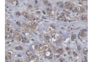 DAB staining on IHC-P; Samples: Human Breast cancer Tissue (EEF2 antibody  (AA 32-233))