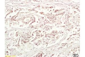 Formalin-fixed and paraffin embedded human gastric carcinoma labeled with Anti-TRAF1 Polyclonal Antibody, Unconjugated (ABIN673464) at 1:200 followed by conjugation to the secondary antibody and DAB staining. (TRAF1 antibody  (AA 301-416))