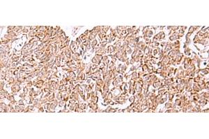 Immunohistochemistry of paraffin-embedded Human ovarian cancer tissue using IRX2 Polyclonal Antibody at dilution of 1:45(x200) (IRX2 antibody)