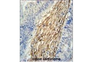 C3orf75 Antibody (C-term) (ABIN651356 and ABIN2840198) immunohistochemistry analysis in formalin fixed and paraffin embedded human colon carcinoma followed by peroxidase conjugation of the secondary antibody and DAB staining. (ELP6 antibody  (C-Term))
