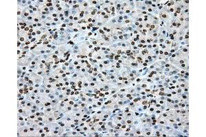 Immunohistochemical staining of paraffin-embedded Adenocarcinoma of colon tissue using anti-CYP1A2 mouse monoclonal antibody. (CYP1A2 antibody)