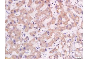 Formalin-fixed and paraffin embedded human lung carcinoma labeled with Rabbit Anti-AP1M2 Polyclonal Antibody, Unconjugated  at 1:200 followed by conjugation to the secondary antibody and DAB staining (AP1m2 antibody  (AA 1-100))