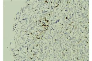 ABIN6272880 at 1/100 staining Human breast cancer tissue by IHC-P. (SGTA antibody  (C-Term))